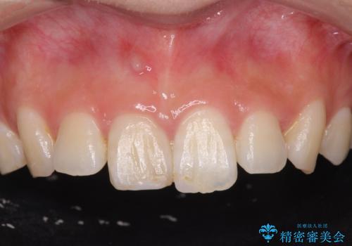[ 前歯のセラミック治療 ]  変色した前歯を綺麗にしたいの症例 治療前