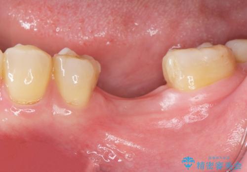 インプラントによる咬合機能回復の治療前