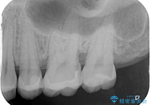歯が欠けた セラミックインレーの治療後