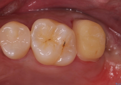 歯ぐきの形を整え、外れにくい被せ物を装着の治療中