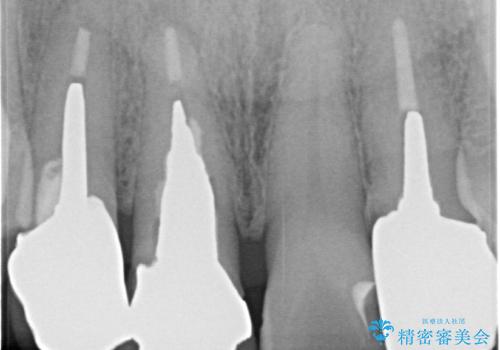 【オールセラミッククラウン】被せ物の色が気になる!の治療前