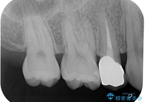 【根管治療歯の補綴】インレーからクラウンへの治療後