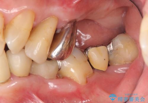 [ 重度歯周病 ]　抜歯後のインプラント治療の症例 治療前