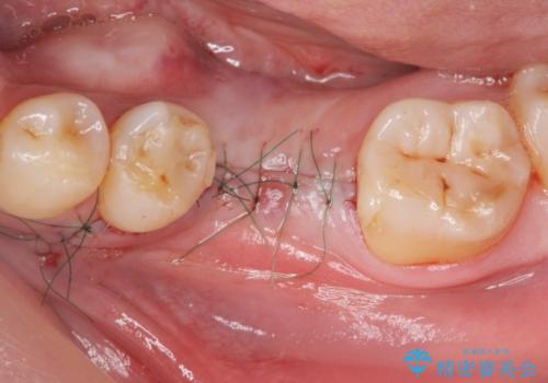 インプラントによる咬合機能回復の治療中