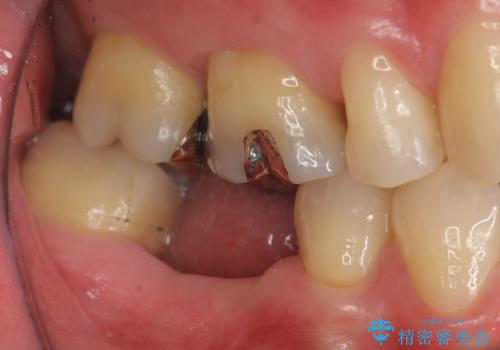 失った歯のインプラント補綴の治療前