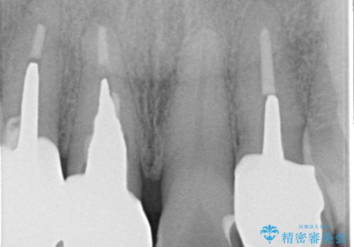 【オールセラミッククラウン】被せ物の色が気になる!の治療後