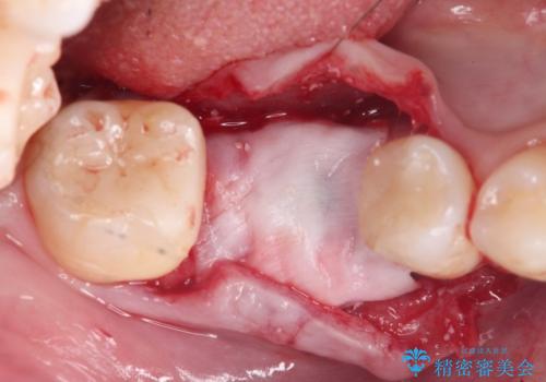 失った歯のインプラント補綴の治療中