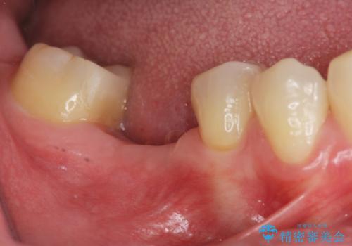 失った歯のインプラント補綴の症例 治療前