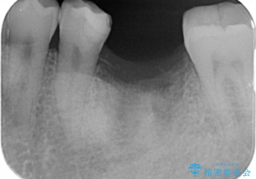 インプラントによる咬合機能回復の治療前
