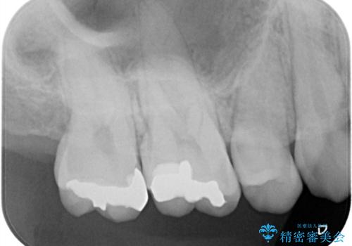 【メタルフリー】金属を白くしたい。の治療前