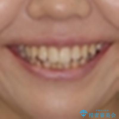 残存乳歯とオープンバイト　インビザラインによる矯正治療の治療前（顔貌）