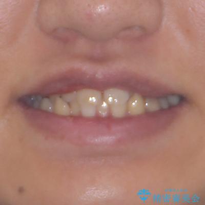 前歯のクロスバイト インビザラインによる矯正治療の治療前(顔貌)