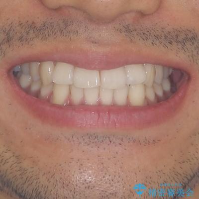 前歯のデコボコを治したい インビザライン矯正治療の治療前(顔貌)