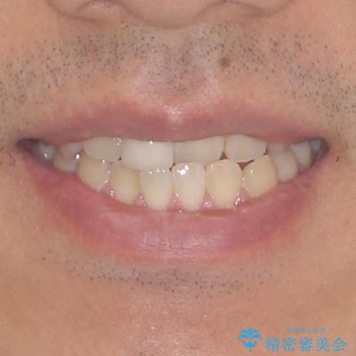 前歯のデコボコとクロスバイトをインビザライン矯正で改善の治療前（顔貌）