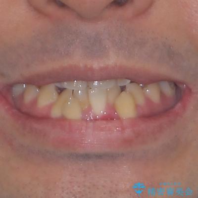 デコボコを治したい　八重歯の抜歯矯正の治療前（顔貌）
