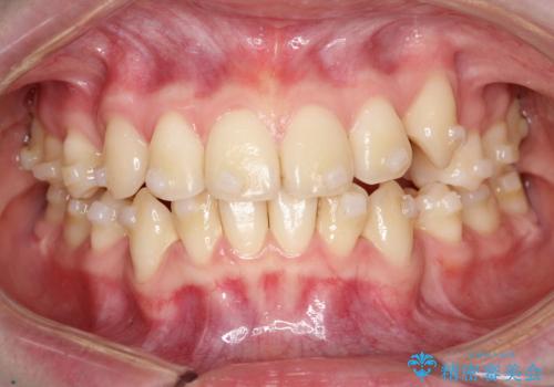 【インビザライン 抜歯ケース】八重歯をなおしたい。の治療中