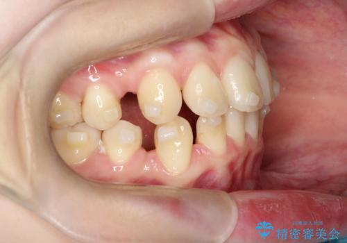 【インビザライン 抜歯ケース】八重歯をなおしたい。の治療中