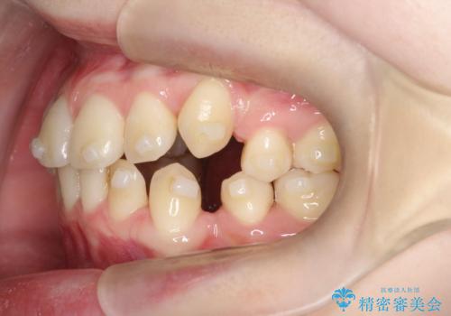 【インビザライン 抜歯ケース】八重歯をなおしたい。の治療中