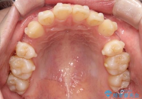 【インビザライン 抜歯ケース】八重歯をなおしたい。の治療中