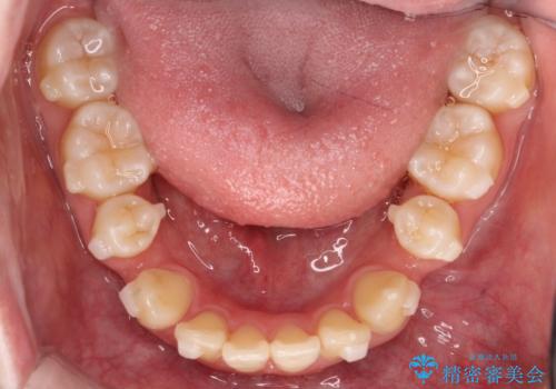 【インビザライン 抜歯ケース】八重歯をなおしたい。の治療中