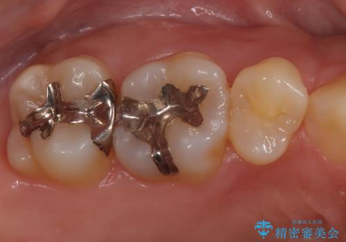 【メタルフリー】金属を白くしたい。の治療前