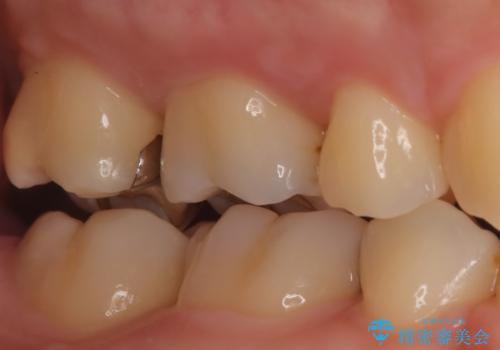 【メタルフリー】金属を白くしたい。の治療前