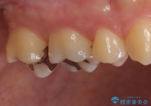 【メタルフリー】金属を白くしたい。の治療前