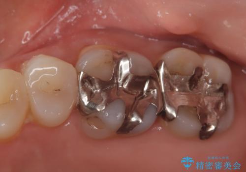 【メタルフリー】セラミックインレーの修復の治療前