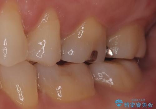 【メタルフリー】セラミックインレーの修復の治療前