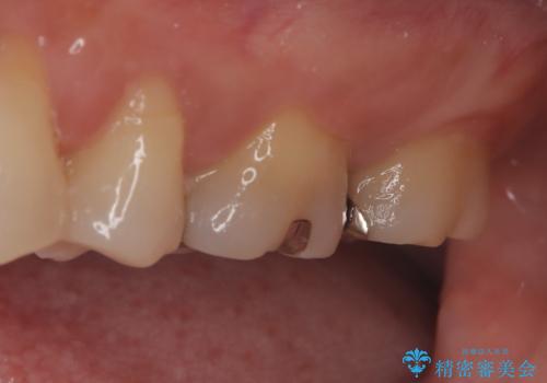 【メタルフリー】セラミックインレーの修復の治療前