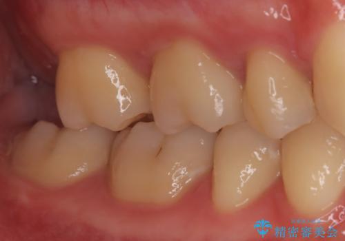 【根管治療歯の補綴】インレーからクラウンへの治療前