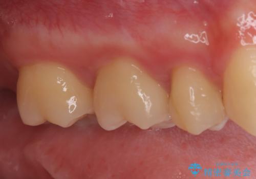 【根管治療歯の補綴】インレーからクラウンへの治療前