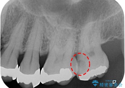 奥歯の虫歯 ゴールドインレーでの修復処置