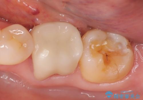 プラスチックが欠けた。の治療前