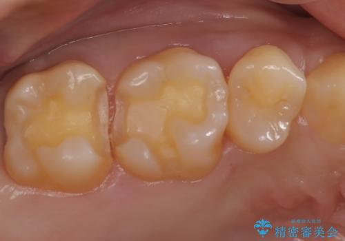 【メタルフリー】金属を白くしたい。の治療中