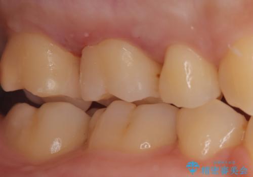 【メタルフリー】金属を白くしたい。の治療後