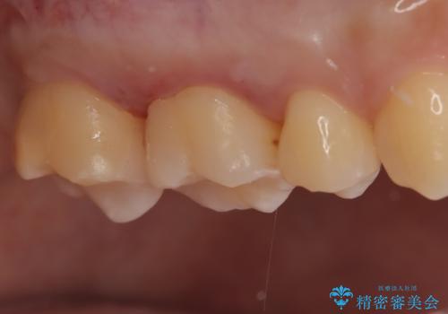 【メタルフリー】金属を白くしたい。の治療後