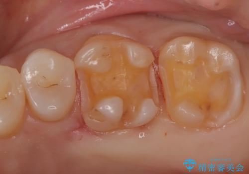 【メタルフリー】セラミックインレーの修復の治療中