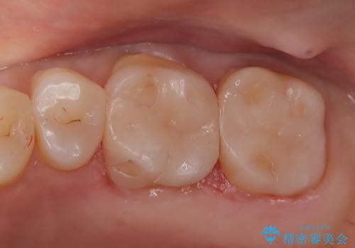 【メタルフリー】セラミックインレーの修復の治療後