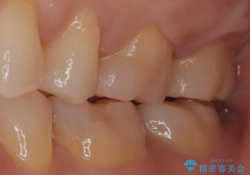 【メタルフリー】セラミックインレーの修復の治療後