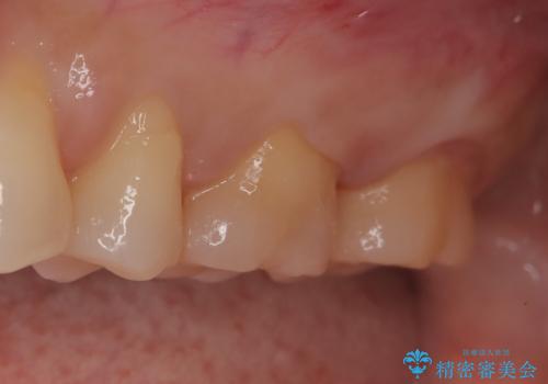【メタルフリー】セラミックインレーの修復の治療後