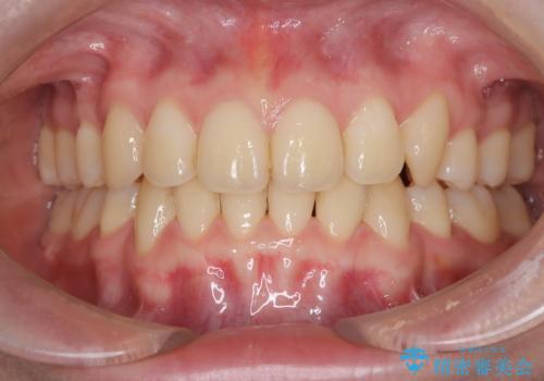 【インビザライン 抜歯ケース】八重歯をなおしたい。の治療後