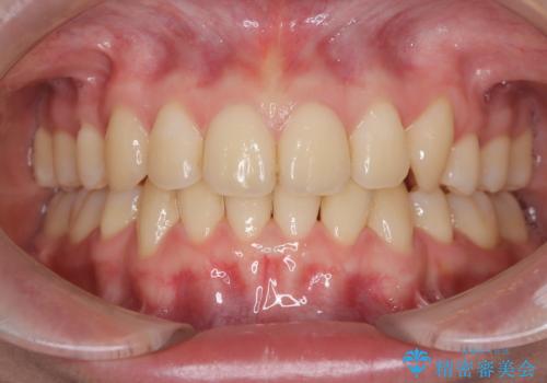 【インビザライン 抜歯ケース】八重歯をなおしたい。