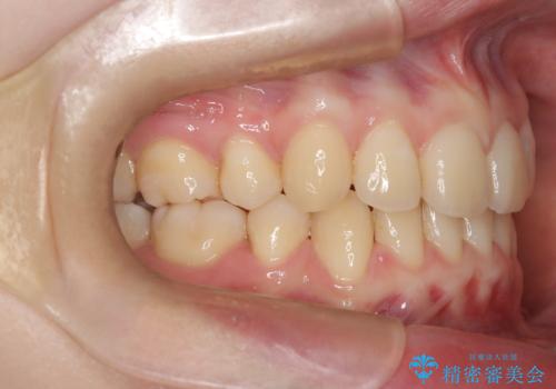 【インビザライン 抜歯ケース】八重歯をなおしたい。の治療後