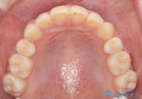 【インビザライン 抜歯ケース】八重歯をなおしたい。の治療後