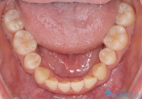 【インビザライン 抜歯ケース】八重歯をなおしたい。の治療後