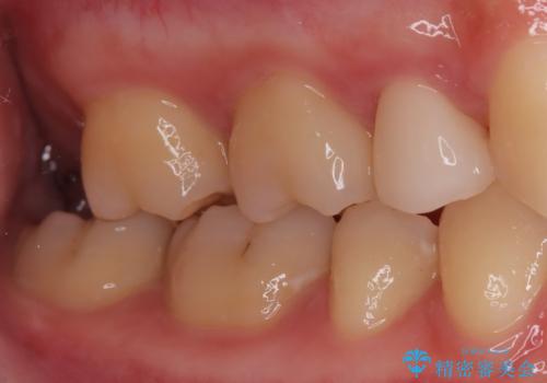 【根管治療歯の補綴】インレーからクラウンへの治療後