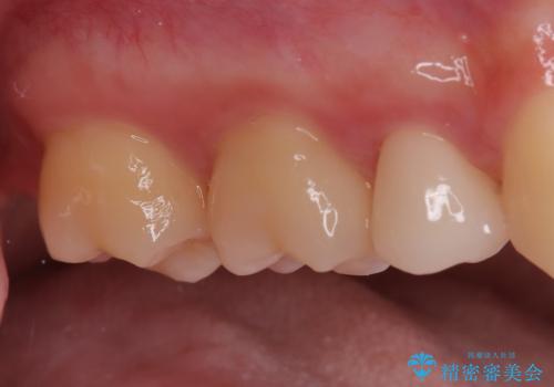 【根管治療歯の補綴】インレーからクラウンへの治療後