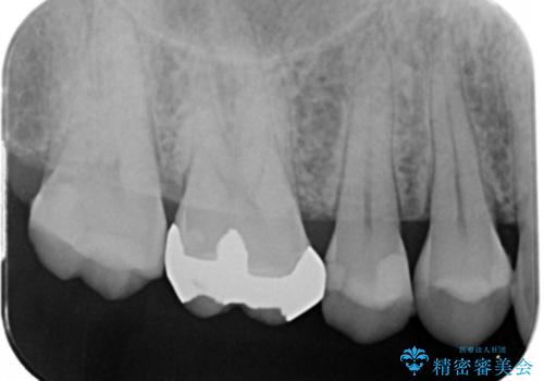 強い咬合力クリアランスの問題を解決したメタルボンドブリッジ治療の治療前