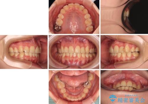 【モニター】再矯正でデコボコの前歯を改善 抜歯矯正の後戻りの治療後